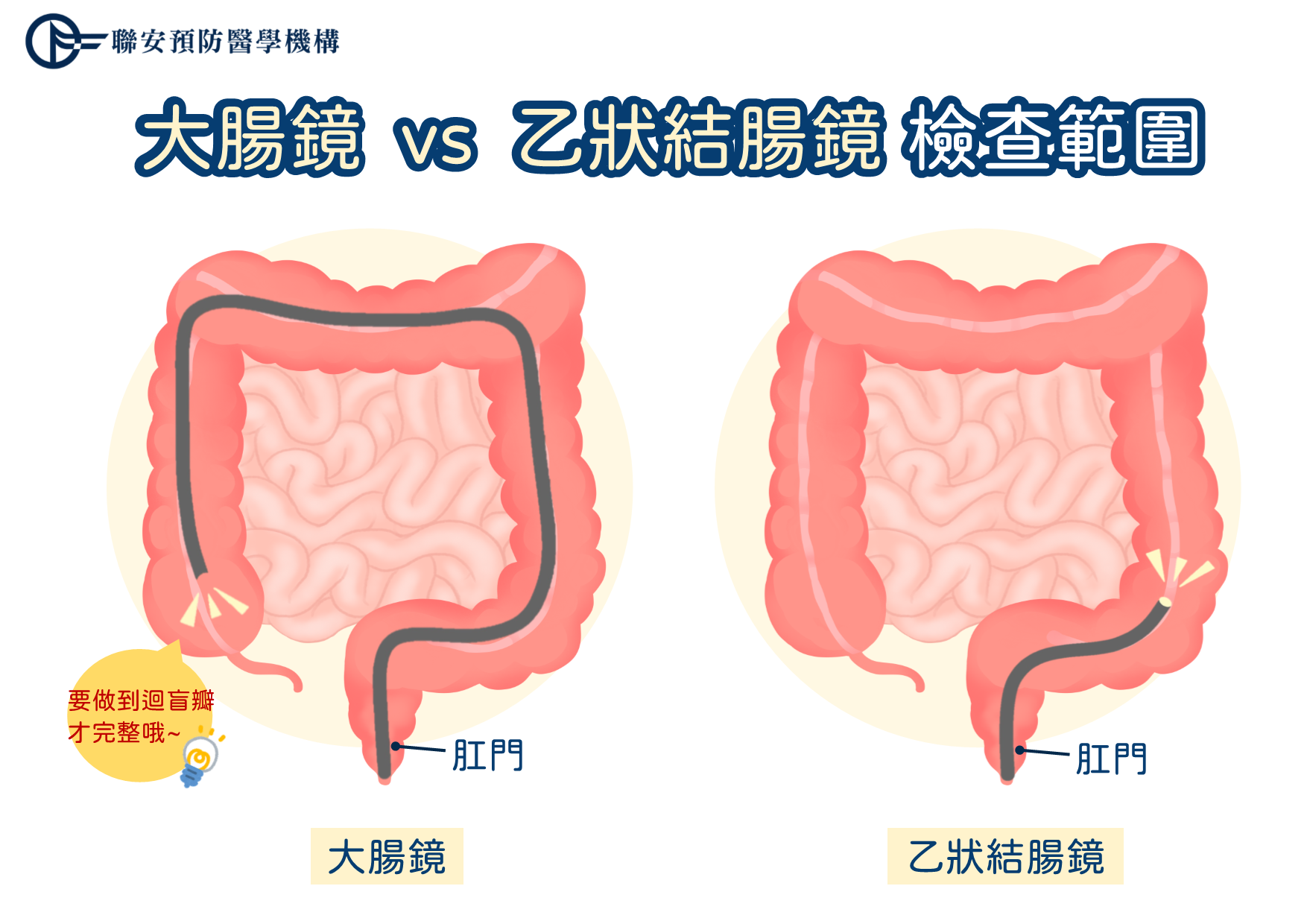 大腸鏡 vs 乙狀結腸鏡