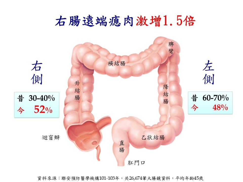 大腸鏡檢查：息肉罹患率攀升