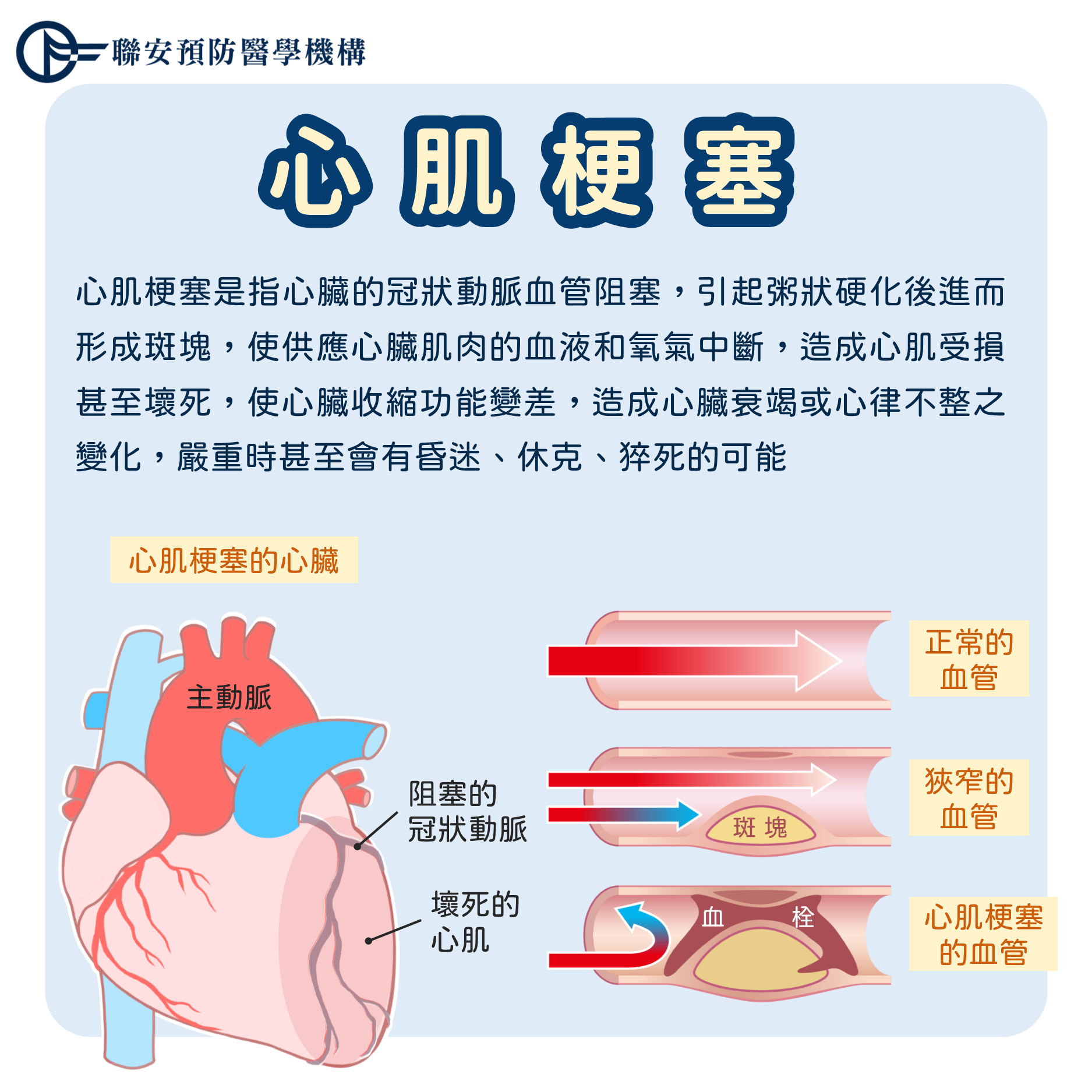 心肌梗塞介紹、症狀